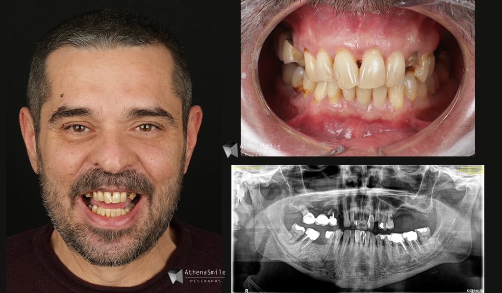 Rehabilitation of maxillary FP1 with advanced periodontitis, non